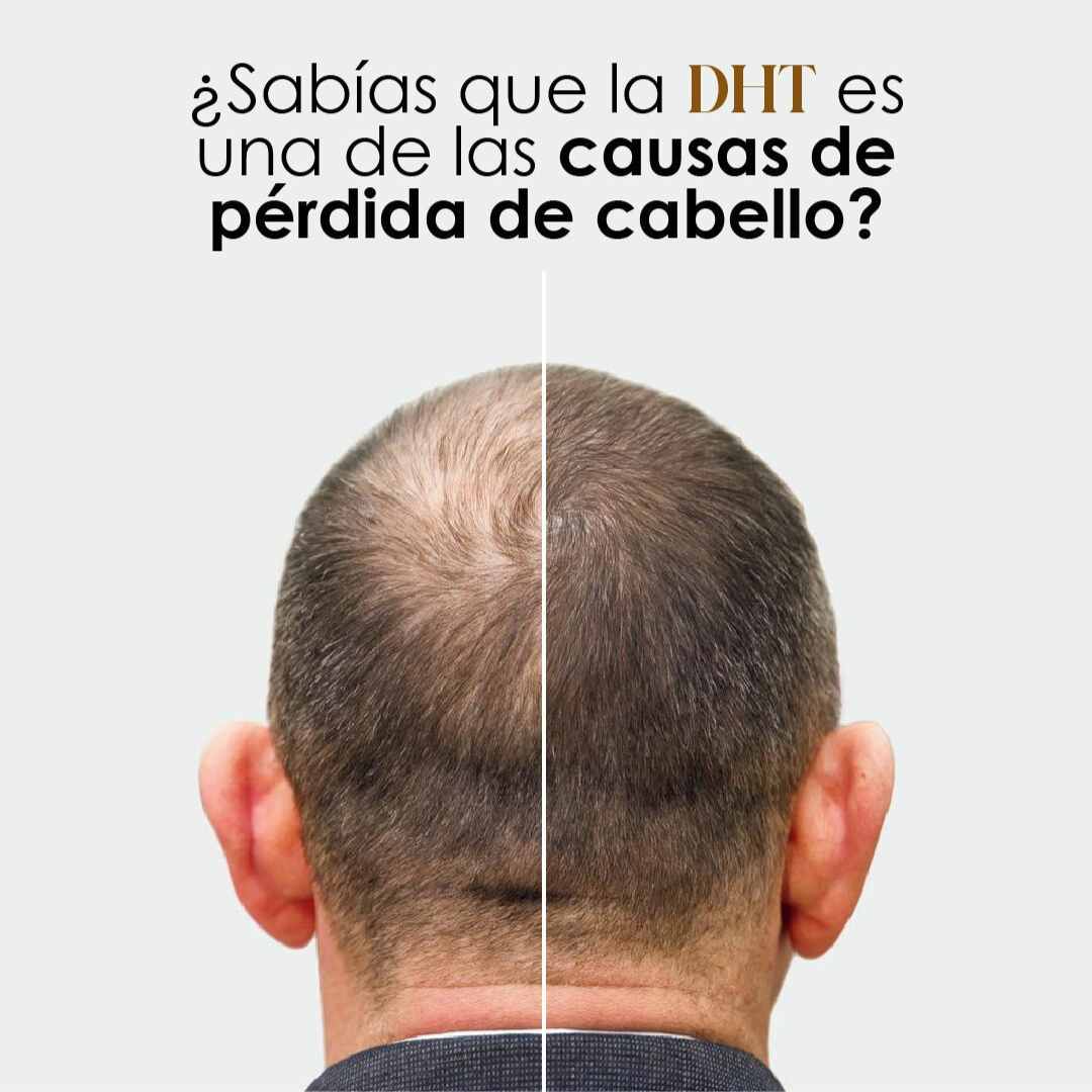 DHT Blocker Anticaída Premium – Cabello Fuerte y Abundante 🧔🏻♂️